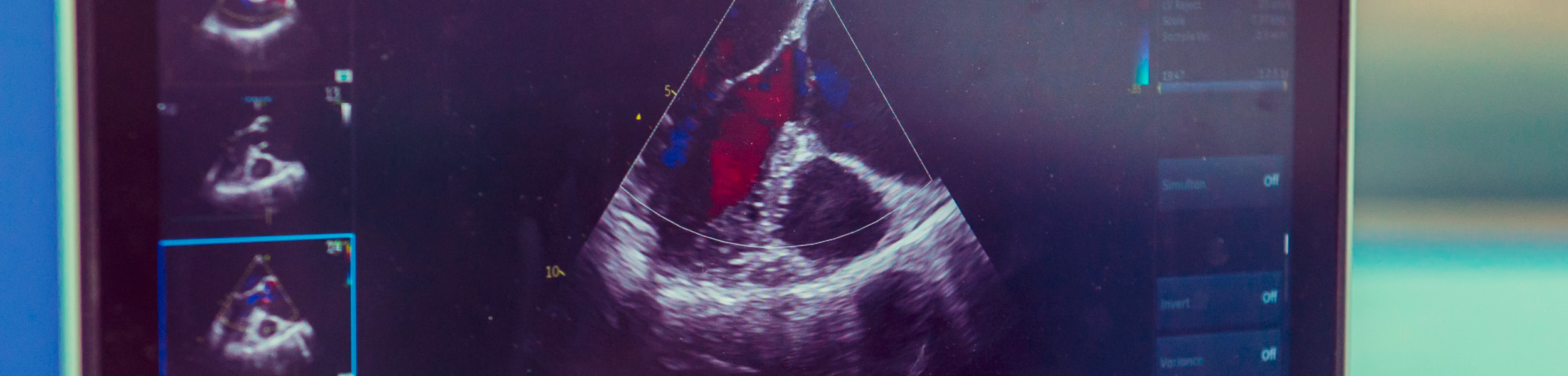 Ein Bildschirm mit laufendem Herz-Ultraschall